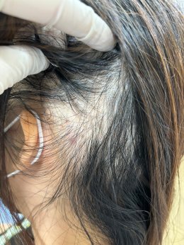Treatment of Alopecia Areata (Patchy Hair Loss) with Chinese Herbal Medicine: A Case Report