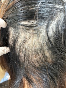 Treatment of Alopecia Areata (Patchy Hair Loss) with Chinese Herbal Medicine: A Case Report