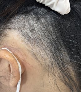 Treatment of Alopecia Areata (Patchy Hair Loss) with Chinese Herbal Medicine: A Case Report