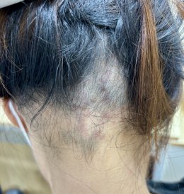 Treatment of Alopecia Areata (Patchy Hair Loss) with Chinese Herbal Medicine: A Case Report