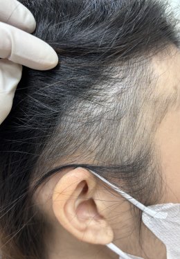 Treatment of Alopecia Areata (Patchy Hair Loss) with Chinese Herbal Medicine: A Case Report