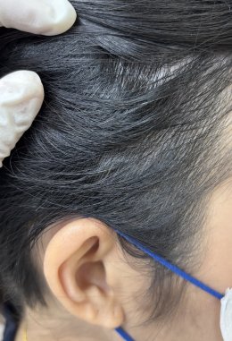 Treatment of Alopecia Areata (Patchy Hair Loss) with Chinese Herbal Medicine: A Case Report