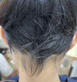 Treatment of Alopecia Areata (Patchy Hair Loss) with Chinese Herbal Medicine: A Case Report