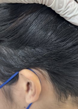 Treatment of Alopecia Areata (Patchy Hair Loss) with Chinese Herbal Medicine: A Case Report