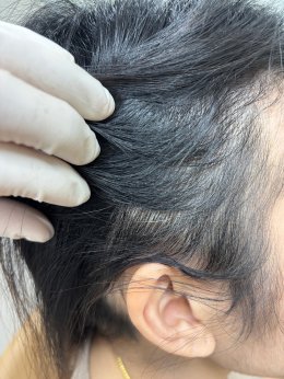 Treatment of Alopecia Areata (Patchy Hair Loss) with Chinese Herbal Medicine: A Case Report