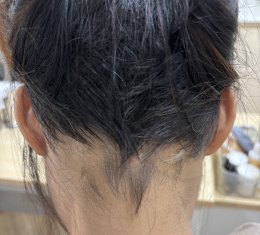 Treatment of Alopecia Areata (Patchy Hair Loss) with Chinese Herbal Medicine: A Case Report