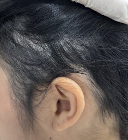 Treatment of Alopecia Areata (Patchy Hair Loss) with Chinese Herbal Medicine: A Case Report