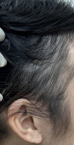 Treatment of Alopecia Areata (Patchy Hair Loss) with Chinese Herbal Medicine: A Case Report
