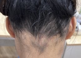 Treatment of Alopecia Areata (Patchy Hair Loss) with Chinese Herbal Medicine: A Case Report