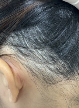 Treatment of Alopecia Areata (Patchy Hair Loss) with Chinese Herbal Medicine: A Case Report