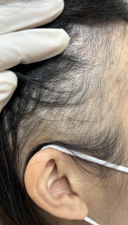 Treatment of Alopecia Areata (Patchy Hair Loss) with Chinese Herbal Medicine: A Case Report