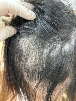 Treatment of Alopecia Areata (Patchy Hair Loss) with Chinese Herbal Medicine: A Case Report