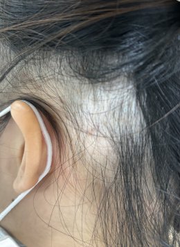 Treatment of Alopecia Areata (Patchy Hair Loss) with Chinese Herbal Medicine: A Case Report