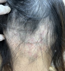 Treatment of Alopecia Areata (Patchy Hair Loss) with Chinese Herbal Medicine: A Case Report
