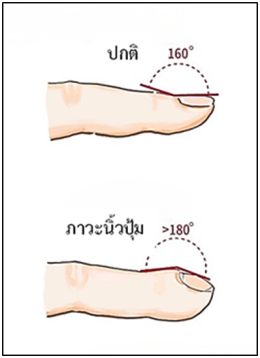 เล็บ ผิดปกติ สัญญาณมะเร็งปอด！