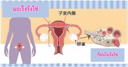 มะเร็งรังไข่ในทัศนะการแพทย์แผนจีน