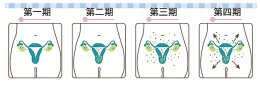 มะเร็งรังไข่ในทัศนะการแพทย์แผนจีน