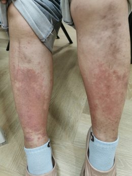 มุมมองการแพทย์แผนจีนต่อกรณีศึกษาผู้ป่วยภูมิแพ้ผื่นผิวหนังอักเสบ น้ำเหลืองซึม คันมาก
