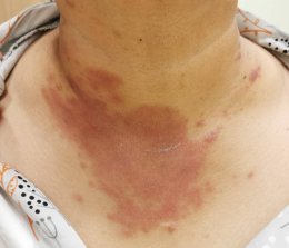 มุมมองการแพทย์แผนจีนต่อกรณีศึกษาผู้ป่วยภูมิแพ้ผื่นผิวหนังอักเสบ น้ำเหลืองซึม คันมาก