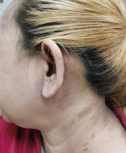 มุมมองการแพทย์แผนจีนต่อกรณีศึกษาผู้ป่วยภูมิแพ้ผื่นผิวหนังอักเสบ น้ำเหลืองซึม คันมาก