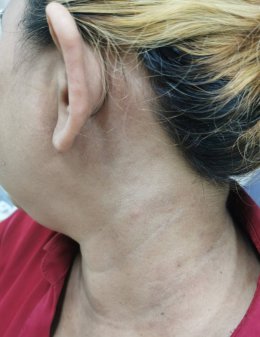 มุมมองการแพทย์แผนจีนต่อกรณีศึกษาผู้ป่วยภูมิแพ้ผื่นผิวหนังอักเสบ น้ำเหลืองซึม คันมาก