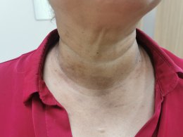มุมมองการแพทย์แผนจีนต่อกรณีศึกษาผู้ป่วยภูมิแพ้ผื่นผิวหนังอักเสบ น้ำเหลืองซึม คันมาก