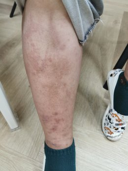 มุมมองการแพทย์แผนจีนต่อกรณีศึกษาผู้ป่วยภูมิแพ้ผื่นผิวหนังอักเสบ น้ำเหลืองซึม คันมาก