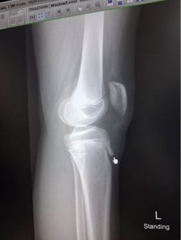 ความกังวลของวัยรุ่น: โรคปุ่มกระดูกหน้าแข้งอักเสบ (Osgood-Schlatter Disease) กับการรักษาแบบบูรณาการด้วยการแพทย์แผนจีน 