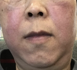 Success case: โรคโรซาเชีย (Rosacea) แก้มแดงปวดแสบปวดร้อน