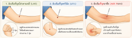 ปวดข้อศอกจากตีแบด...ฝังเข็มช่วยได้