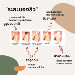 "เข้าใจสิว" ตั้งแต่ต้อนจนจบการรักษา ในโพสต์เดียว