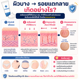 ผิวแตกลายจากครีมที่แอบผสมยาสเตอรอยด์