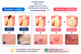 ประเภทสิว สิวมีกี่ประเภท สิวอุดตัน สิวอักเสบ สิวผด  บทความโดยเภสัชกร