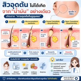เป็นคนผิวแห้ง แต่สิวอุดตันขึ้นง่ายมาก เพราะอะไร บทความโดยเภสัชกร