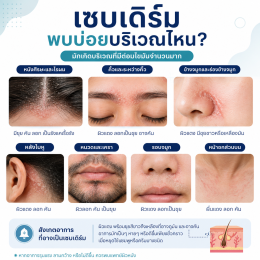 เซบเดิร์ม (Seborrheic Dermatitis) คืออะไร? สาเหตุ อาการ และวิธีรักษา  บทความโดยเภสัชกร 