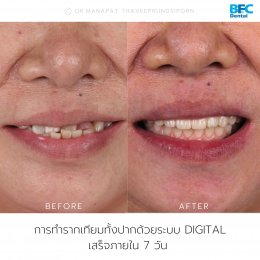 Full Mouth Implant Rehabilitation With Full Digital Workflow in 7 Days Case by Dr.Manapat Thaveeprungsiporn