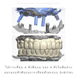 Full Mouth Implant Rehabilitation With Full Digital Workflow in 7 Days 