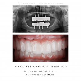 BFC Full Mouth Implant Rehabilitation With Full Digital Workflow