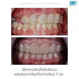 Full Mouth Implant Rehabilitation (for Upper Arch) With Full Digital Workflow in 7 Days 