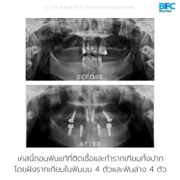 Full Mouth Dental Implants (All on 4 Dental Implants)