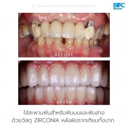 Full Mouth Implants With Full Digital Workflow in 7 Days Case by Dr.Manapat Thaveeprungsiporn