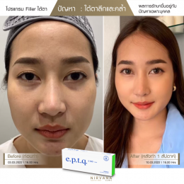 Review Filler ใต้ตา