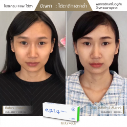 Review Filler ใต้ตา