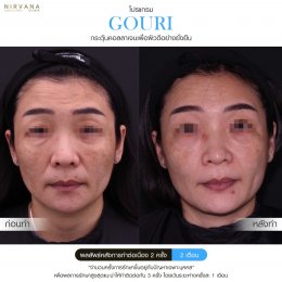 Gouri Collagen PCL 21% สร้างคอลลาเจนอย่างยั่งยืน เปลี่ยนผิวเก่าเป็นผิวใหม่