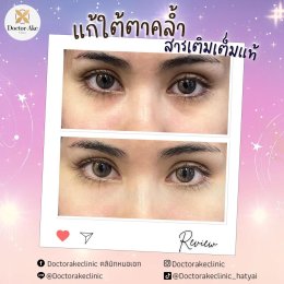 Filler ใต้ตา