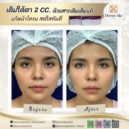 Filler ใต้ตา