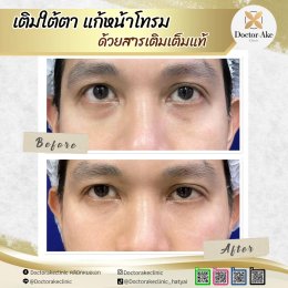 Filler ใต้ตา