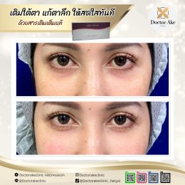 Filler ใต้ตา