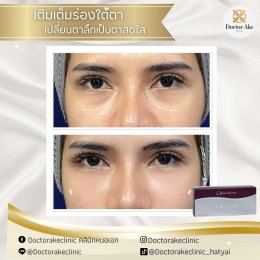 Filler ใต้ตา