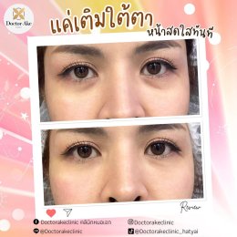 Filler ใต้ตา